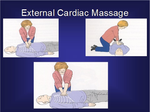 External Cardiac Massage External Cardiac Massage